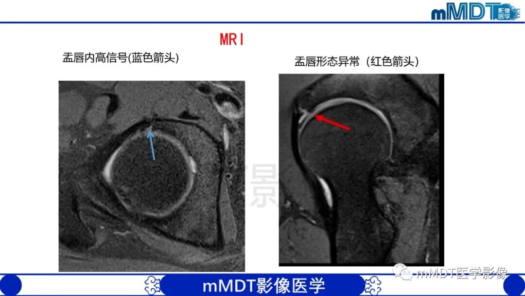 mmd在医学上什么意思股骨髋臼撞击症影像学改变_https://www.jmylbn.com_新闻资讯_第38张