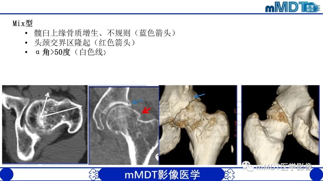 mmd在医学上什么意思股骨髋臼撞击症影像学改变_https://www.jmylbn.com_新闻资讯_第32张