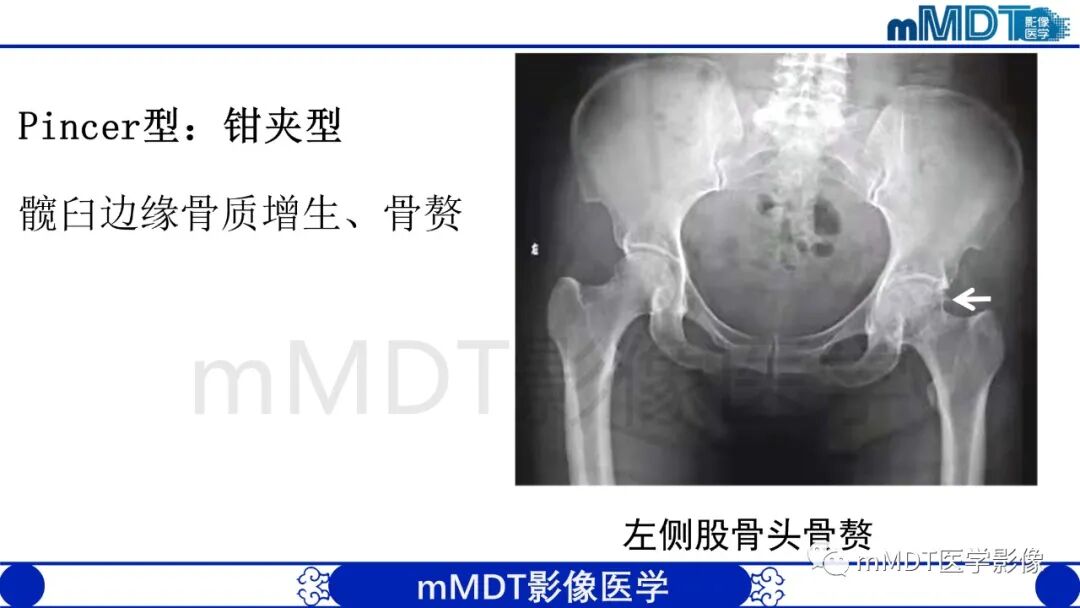 mmd在医学上什么意思股骨髋臼撞击症影像学改变_https://www.jmylbn.com_新闻资讯_第20张