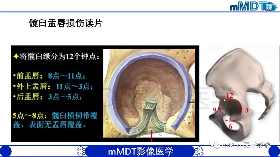 mmd在医学上什么意思股骨髋臼撞击症影像学改变_https://www.jmylbn.com_新闻资讯_第36张