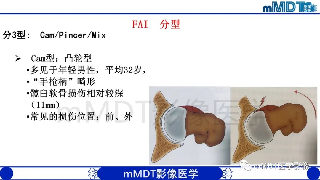 mmd在医学上什么意思股骨髋臼撞击症影像学改变_https://www.jmylbn.com_新闻资讯_第9张