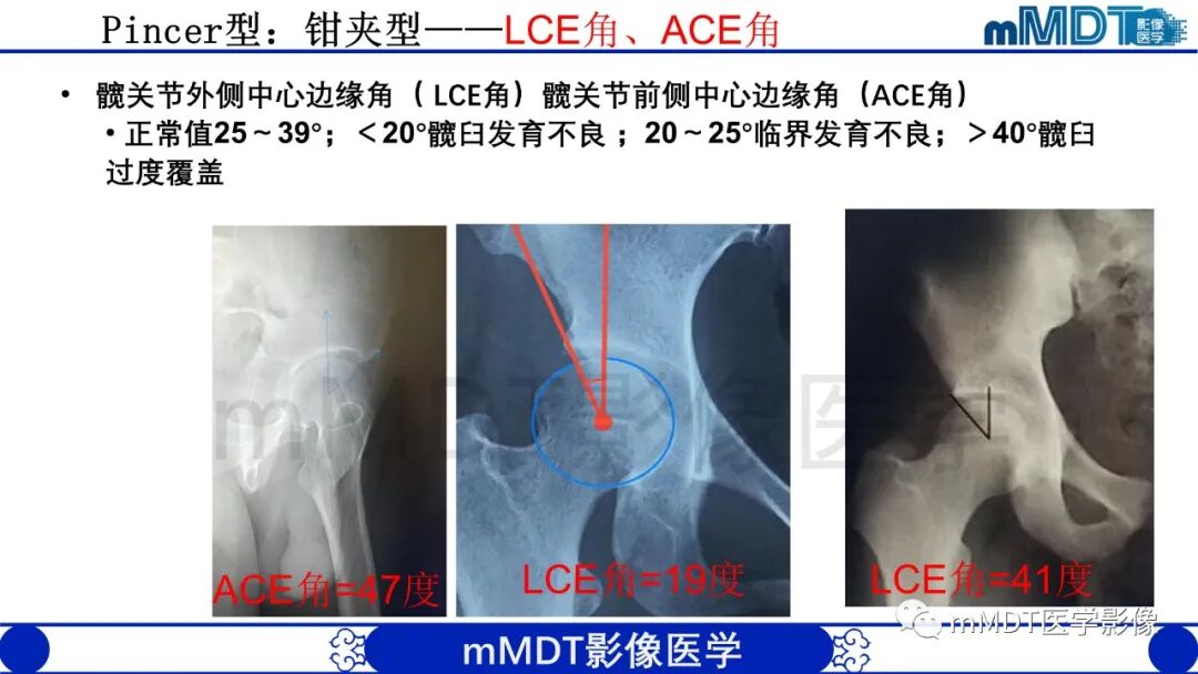 mmd在医学上什么意思股骨髋臼撞击症影像学改变_https://www.jmylbn.com_新闻资讯_第21张