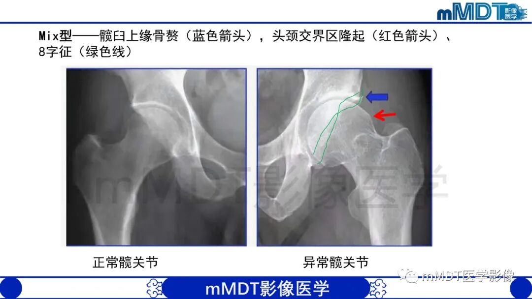 mmd在医学上什么意思股骨髋臼撞击症影像学改变_https://www.jmylbn.com_新闻资讯_第26张