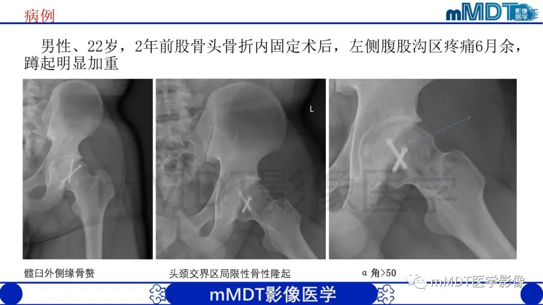 mmd在医学上什么意思股骨髋臼撞击症影像学改变_https://www.jmylbn.com_新闻资讯_第42张