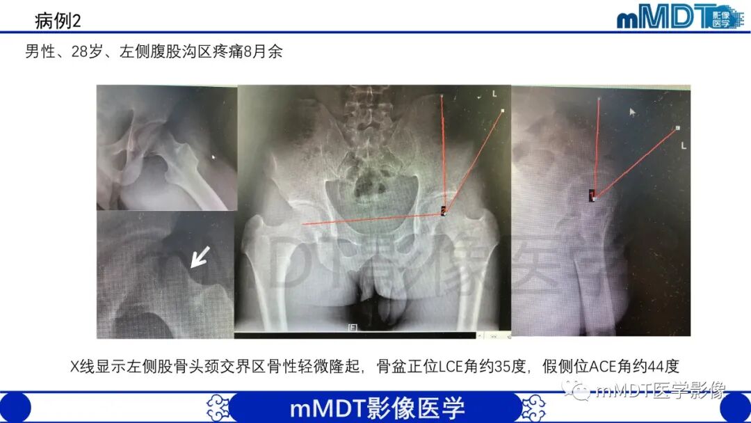 mmd在医学上什么意思股骨髋臼撞击症影像学改变_https://www.jmylbn.com_新闻资讯_第48张