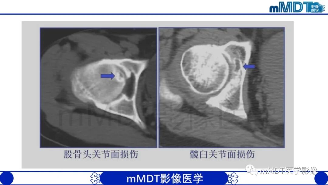 mmd在医学上什么意思股骨髋臼撞击症影像学改变_https://www.jmylbn.com_新闻资讯_第28张
