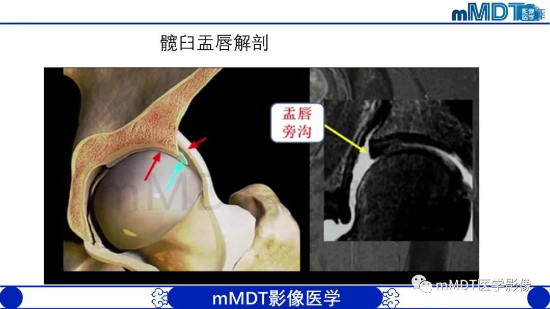 mmd在医学上什么意思股骨髋臼撞击症影像学改变_https://www.jmylbn.com_新闻资讯_第8张