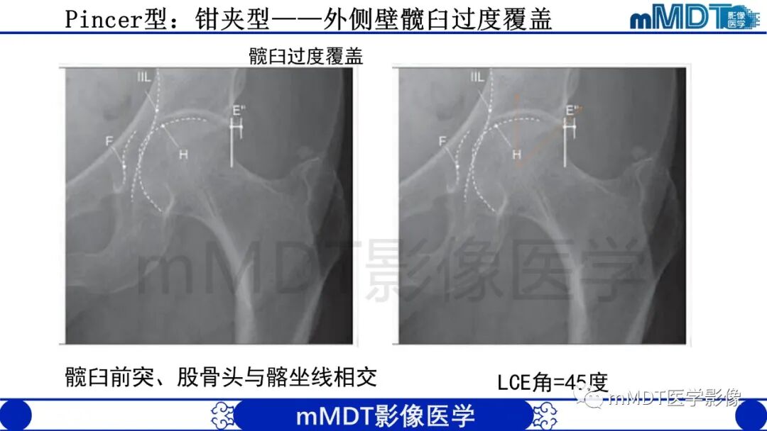 mmd在医学上什么意思股骨髋臼撞击症影像学改变_https://www.jmylbn.com_新闻资讯_第25张