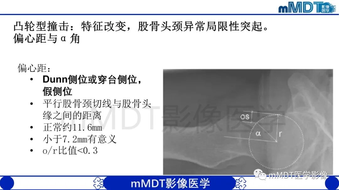 mmd在医学上什么意思股骨髋臼撞击症影像学改变_https://www.jmylbn.com_新闻资讯_第17张