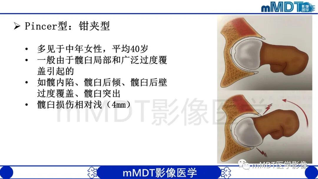 mmd在医学上什么意思股骨髋臼撞击症影像学改变_https://www.jmylbn.com_新闻资讯_第10张