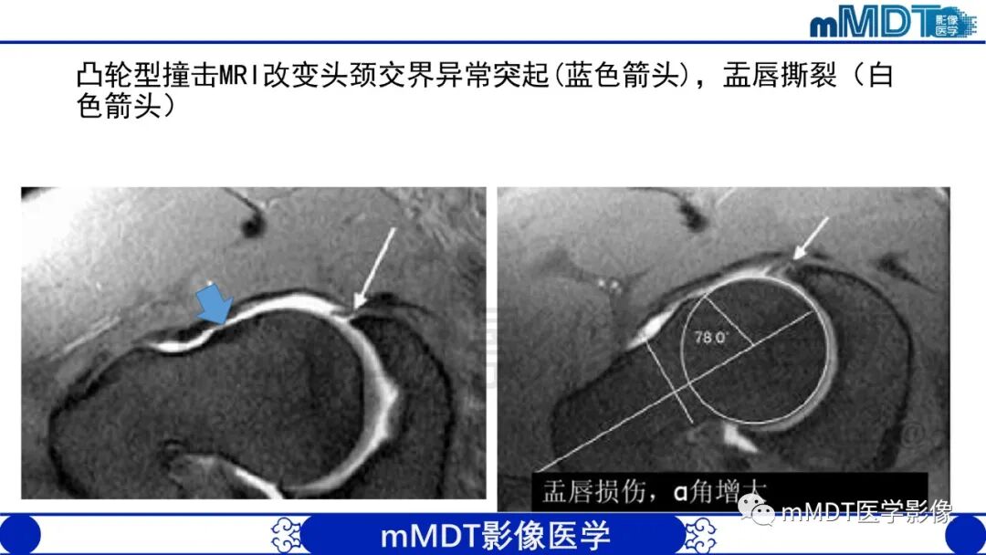 mmd在医学上什么意思股骨髋臼撞击症影像学改变_https://www.jmylbn.com_新闻资讯_第37张