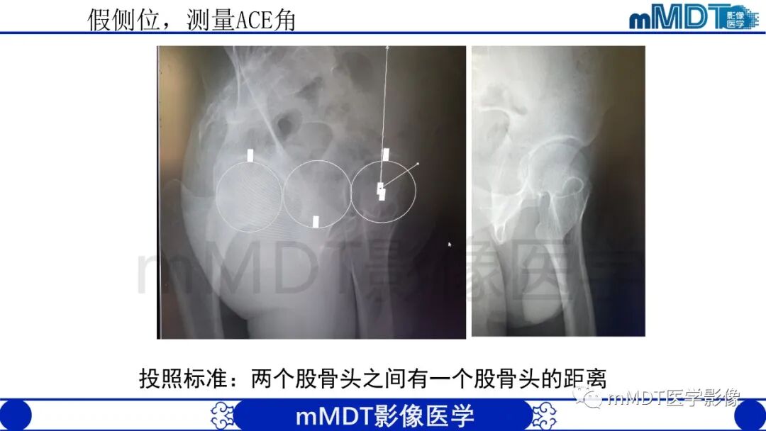 mmd在医学上什么意思股骨髋臼撞击症影像学改变_https://www.jmylbn.com_新闻资讯_第15张