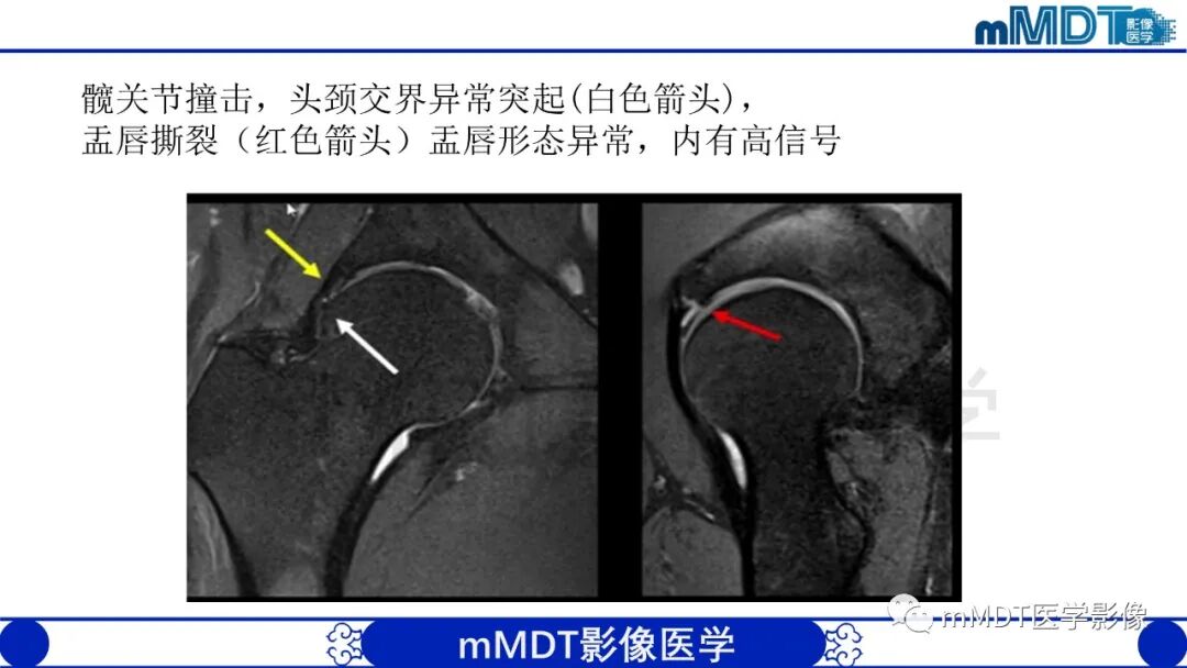 mmd在医学上什么意思股骨髋臼撞击症影像学改变_https://www.jmylbn.com_新闻资讯_第40张