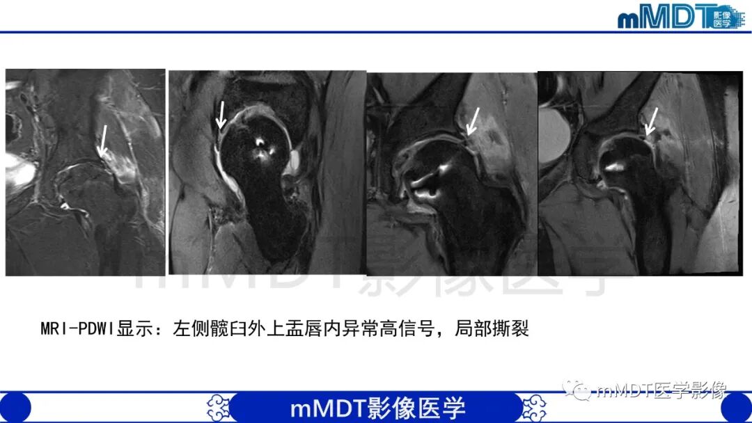 mmd在医学上什么意思股骨髋臼撞击症影像学改变_https://www.jmylbn.com_新闻资讯_第46张