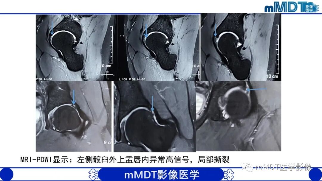 mmd在医学上什么意思股骨髋臼撞击症影像学改变_https://www.jmylbn.com_新闻资讯_第49张