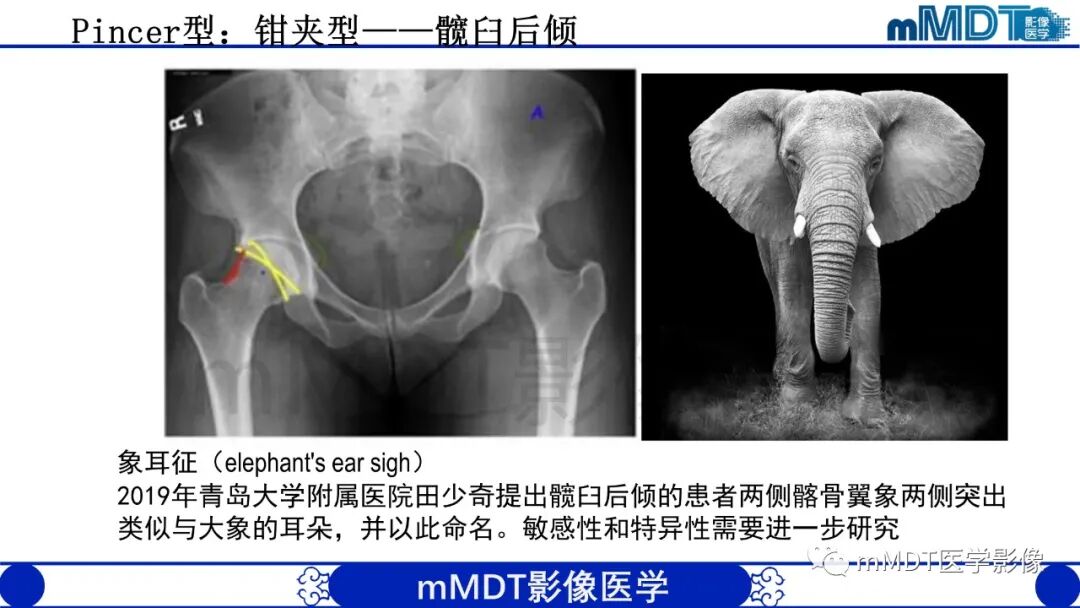 mmd在医学上什么意思股骨髋臼撞击症影像学改变_https://www.jmylbn.com_新闻资讯_第24张