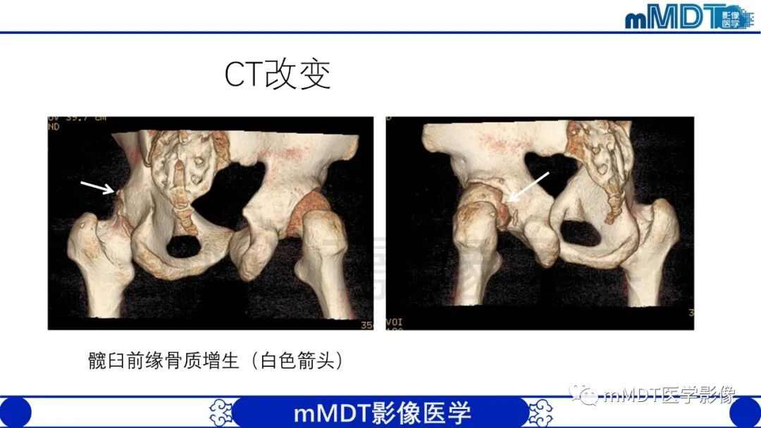 mmd在医学上什么意思股骨髋臼撞击症影像学改变_https://www.jmylbn.com_新闻资讯_第45张