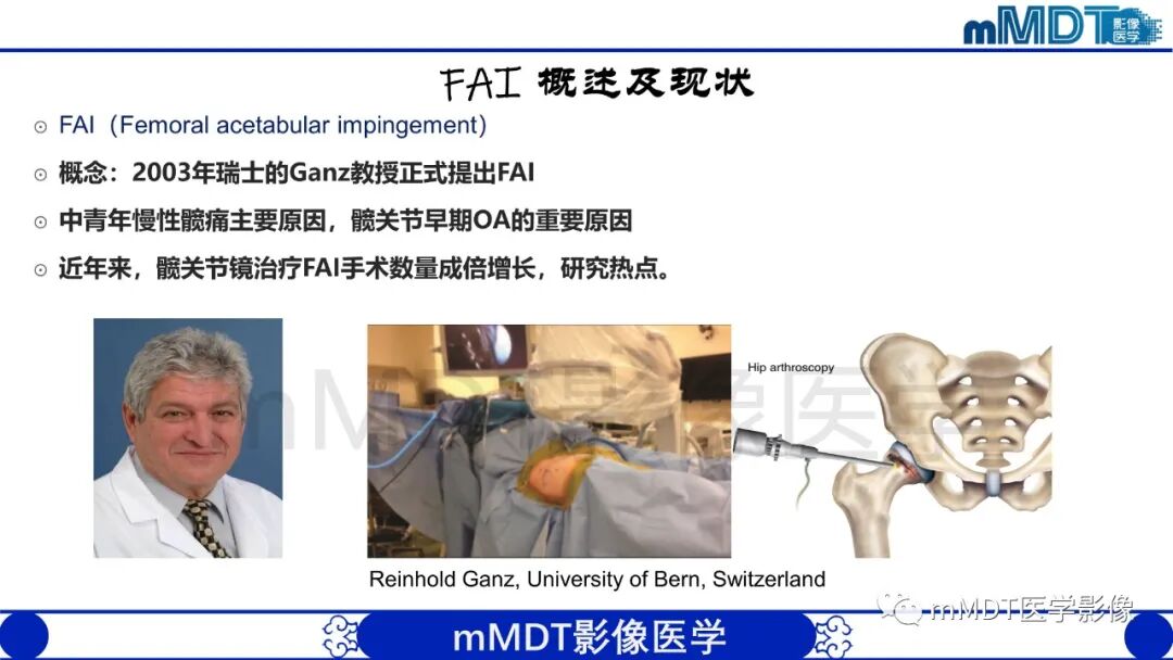 mmd在医学上什么意思股骨髋臼撞击症影像学改变_https://www.jmylbn.com_新闻资讯_第4张