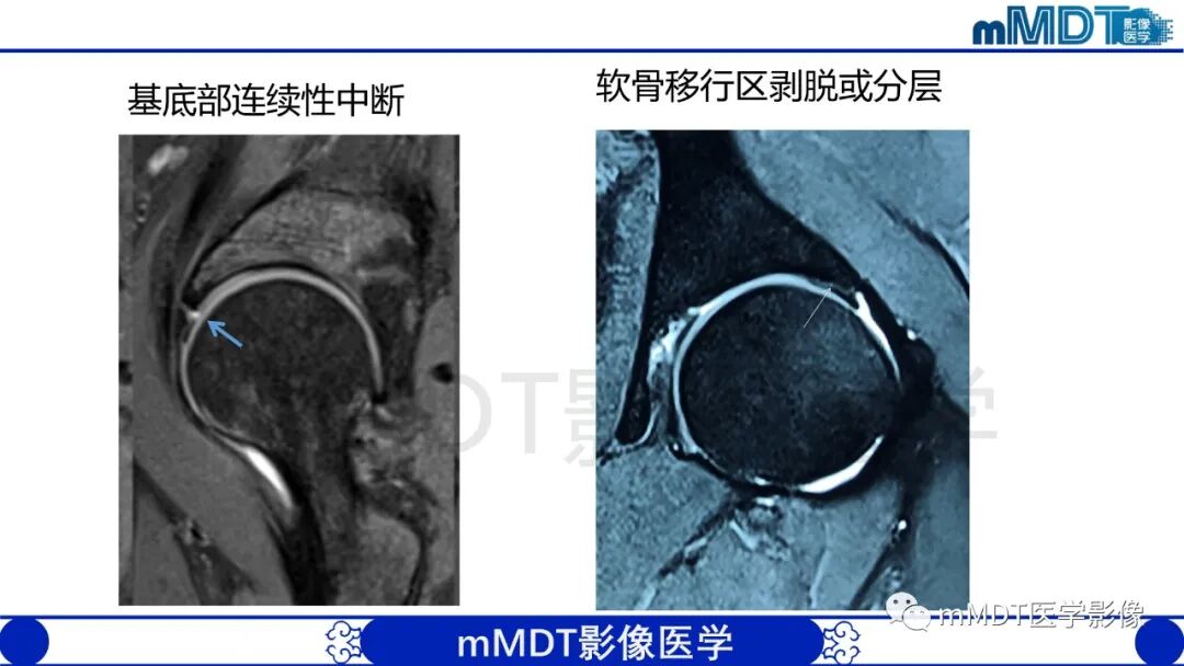mmd在医学上什么意思股骨髋臼撞击症影像学改变_https://www.jmylbn.com_新闻资讯_第39张