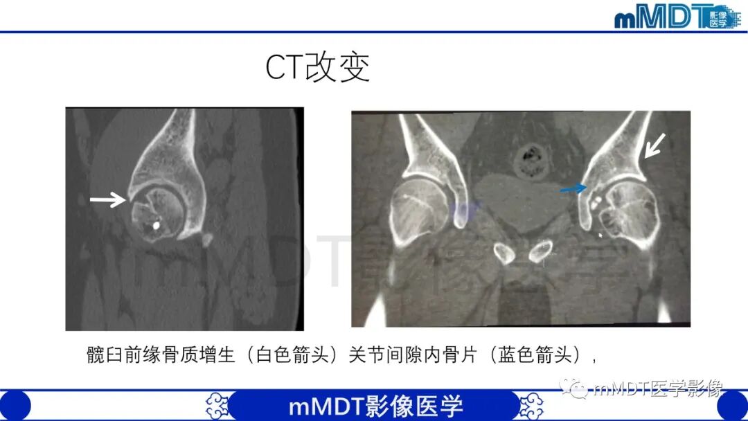 mmd在医学上什么意思股骨髋臼撞击症影像学改变_https://www.jmylbn.com_新闻资讯_第44张