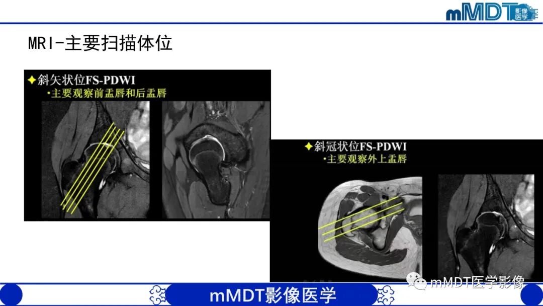 mmd在医学上什么意思股骨髋臼撞击症影像学改变_https://www.jmylbn.com_新闻资讯_第34张