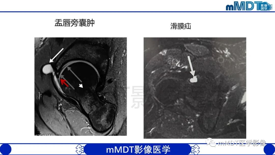 mmd在医学上什么意思股骨髋臼撞击症影像学改变_https://www.jmylbn.com_新闻资讯_第41张