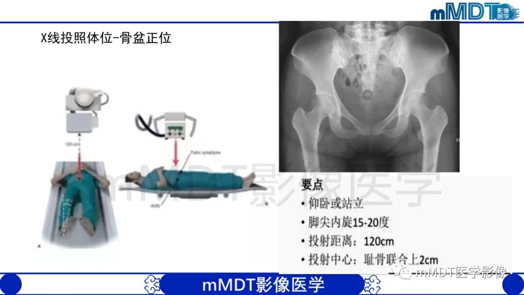 mmd在医学上什么意思股骨髋臼撞击症影像学改变_https://www.jmylbn.com_新闻资讯_第13张