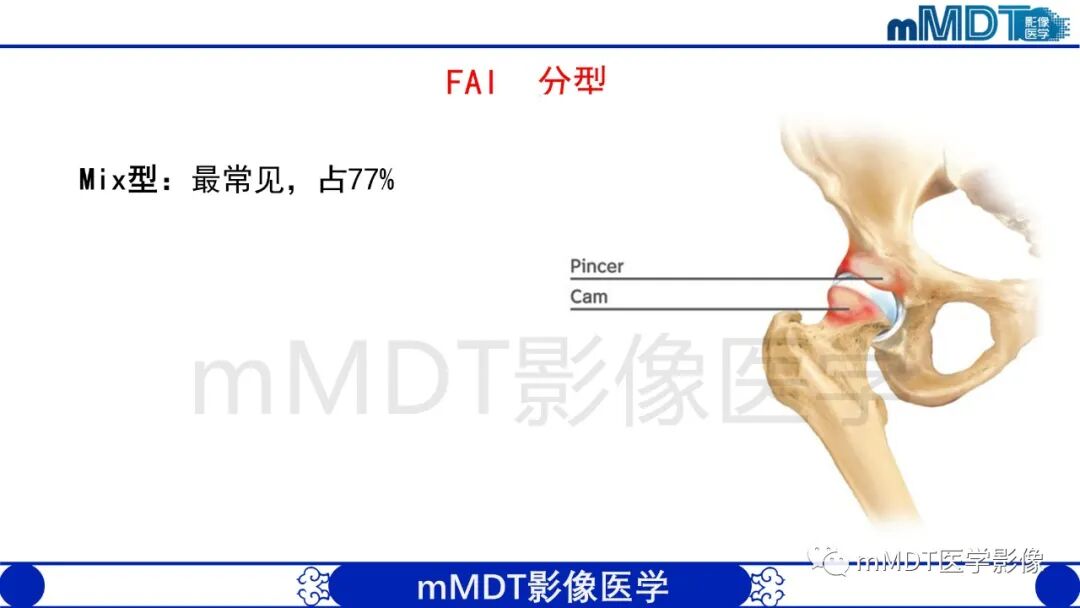 mmd在医学上什么意思股骨髋臼撞击症影像学改变_https://www.jmylbn.com_新闻资讯_第11张
