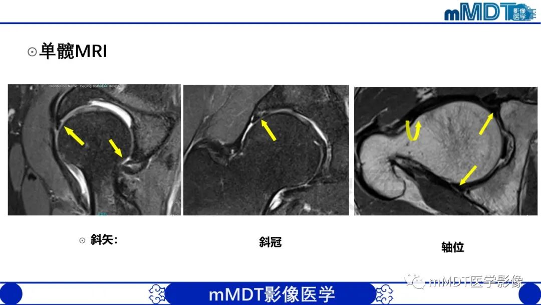 mmd在医学上什么意思股骨髋臼撞击症影像学改变_https://www.jmylbn.com_新闻资讯_第35张