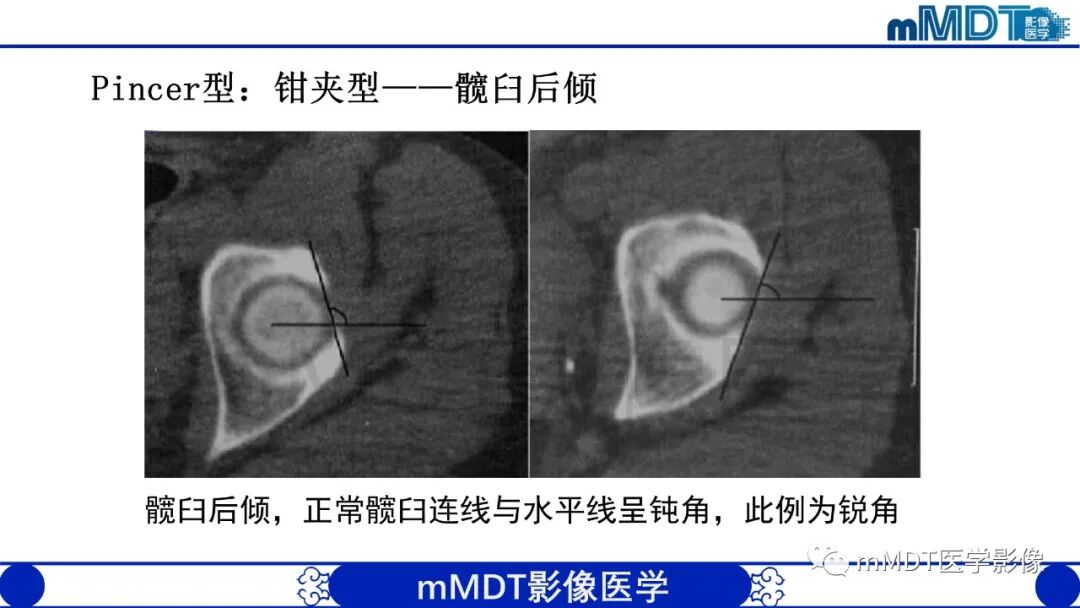 mmd在医学上什么意思股骨髋臼撞击症影像学改变_https://www.jmylbn.com_新闻资讯_第30张