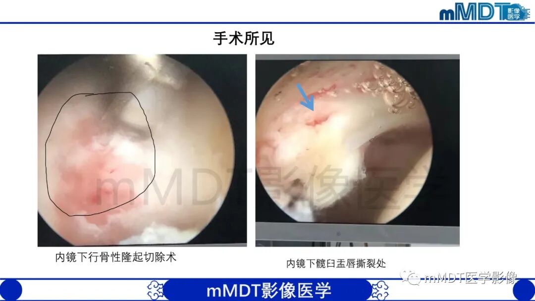 mmd在医学上什么意思股骨髋臼撞击症影像学改变_https://www.jmylbn.com_新闻资讯_第47张