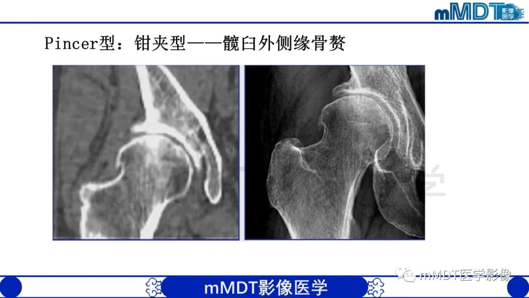 mmd在医学上什么意思股骨髋臼撞击症影像学改变_https://www.jmylbn.com_新闻资讯_第31张