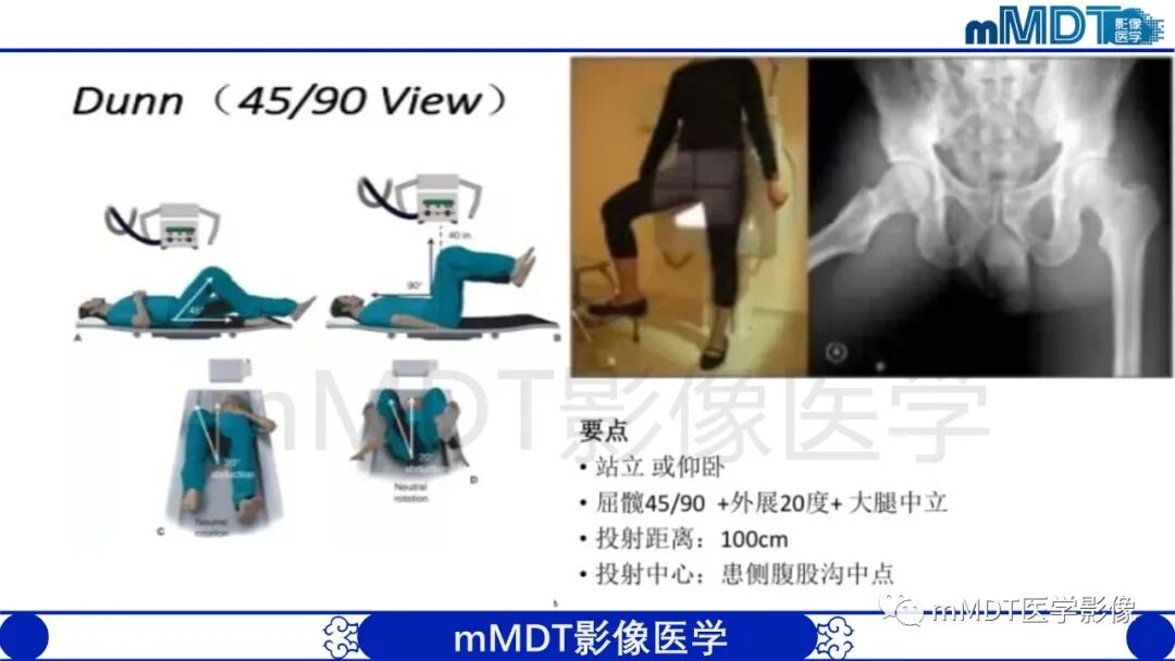 mmd在医学上什么意思股骨髋臼撞击症影像学改变_https://www.jmylbn.com_新闻资讯_第16张