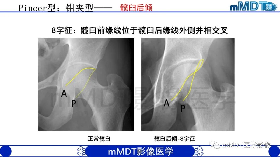mmd在医学上什么意思股骨髋臼撞击症影像学改变_https://www.jmylbn.com_新闻资讯_第22张