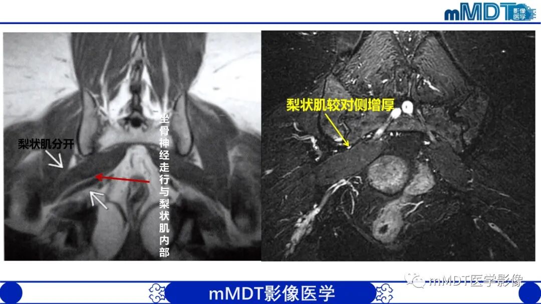 mmd在医学上什么意思髋关节疼痛影像与临床（二）--王勇老师公开课_https://www.jmylbn.com_新闻资讯_第18张