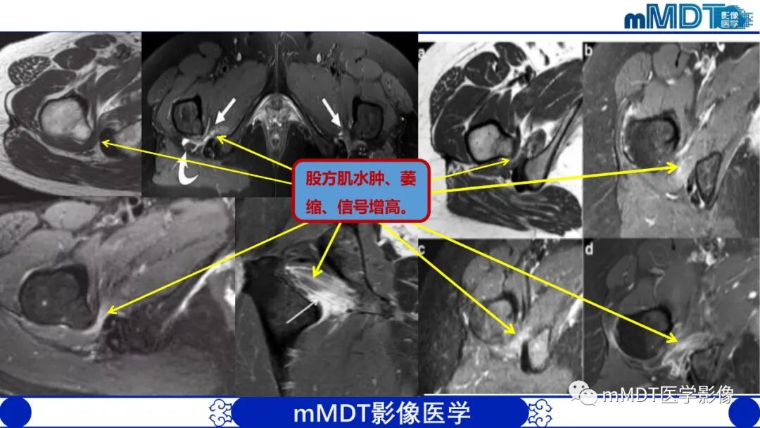 mmd在医学上什么意思髋关节疼痛影像与临床（二）--王勇老师公开课_https://www.jmylbn.com_新闻资讯_第8张