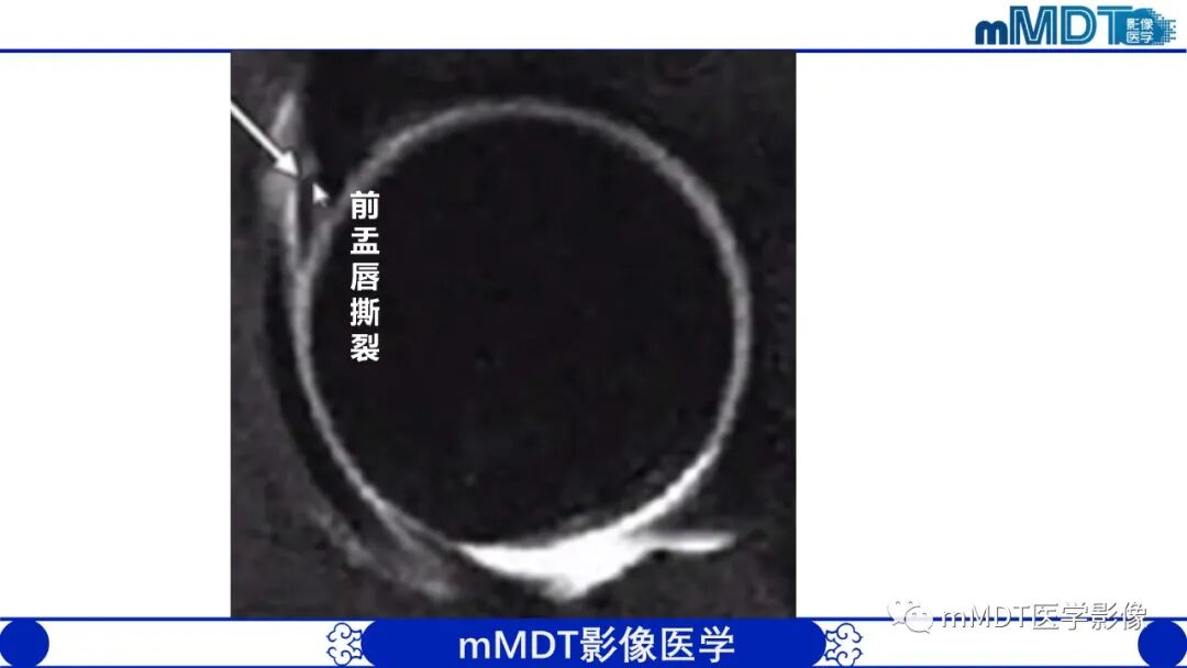 mmd在医学上什么意思髋关节疼痛影像与临床（二）--王勇老师公开课_https://www.jmylbn.com_新闻资讯_第14张