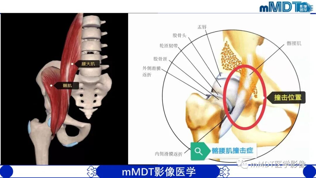 mmd在医学上什么意思髋关节疼痛影像与临床（二）--王勇老师公开课_https://www.jmylbn.com_新闻资讯_第12张