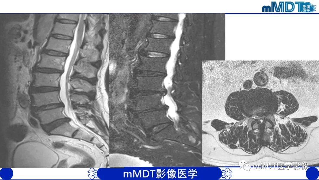 mmd在医学上什么意思髋关节疼痛影像与临床（二）--王勇老师公开课_https://www.jmylbn.com_新闻资讯_第20张