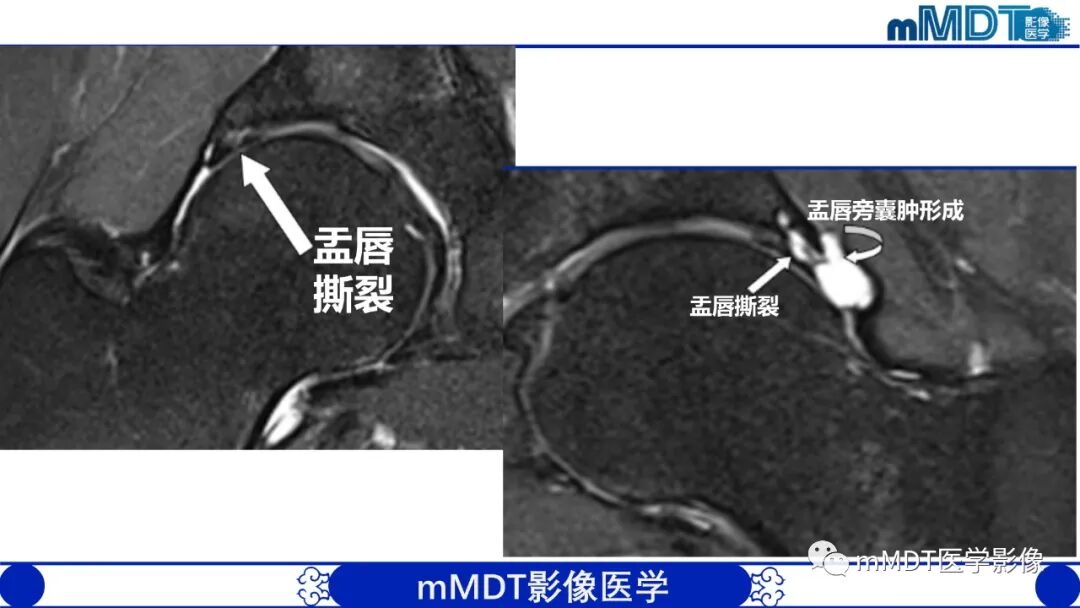 mmd在医学上什么意思髋关节疼痛影像与临床（二）--王勇老师公开课_https://www.jmylbn.com_新闻资讯_第26张