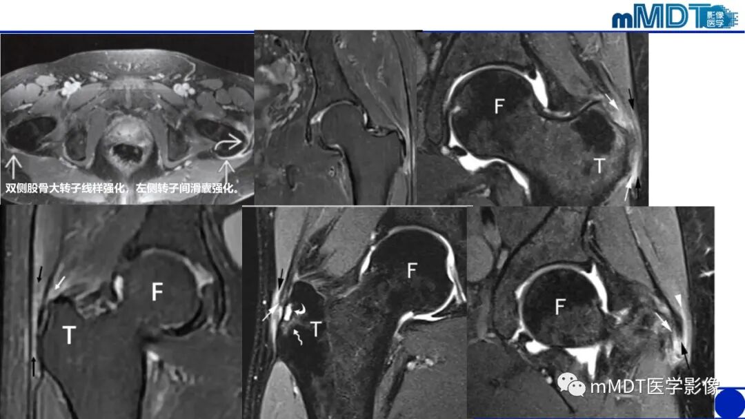 mmd在医学上什么意思髋关节疼痛影像与临床（二）--王勇老师公开课_https://www.jmylbn.com_新闻资讯_第16张