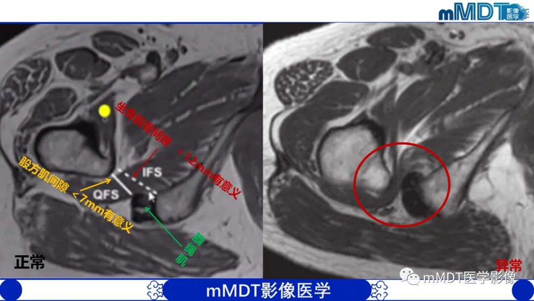 mmd在医学上什么意思髋关节疼痛影像与临床（二）--王勇老师公开课_https://www.jmylbn.com_新闻资讯_第7张