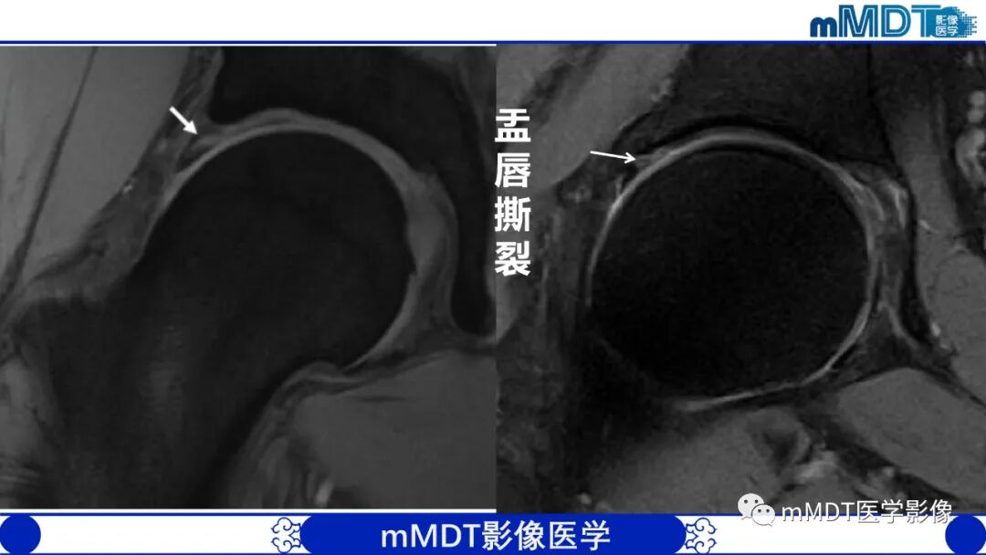 mmd在医学上什么意思髋关节疼痛影像与临床（二）--王勇老师公开课_https://www.jmylbn.com_新闻资讯_第25张