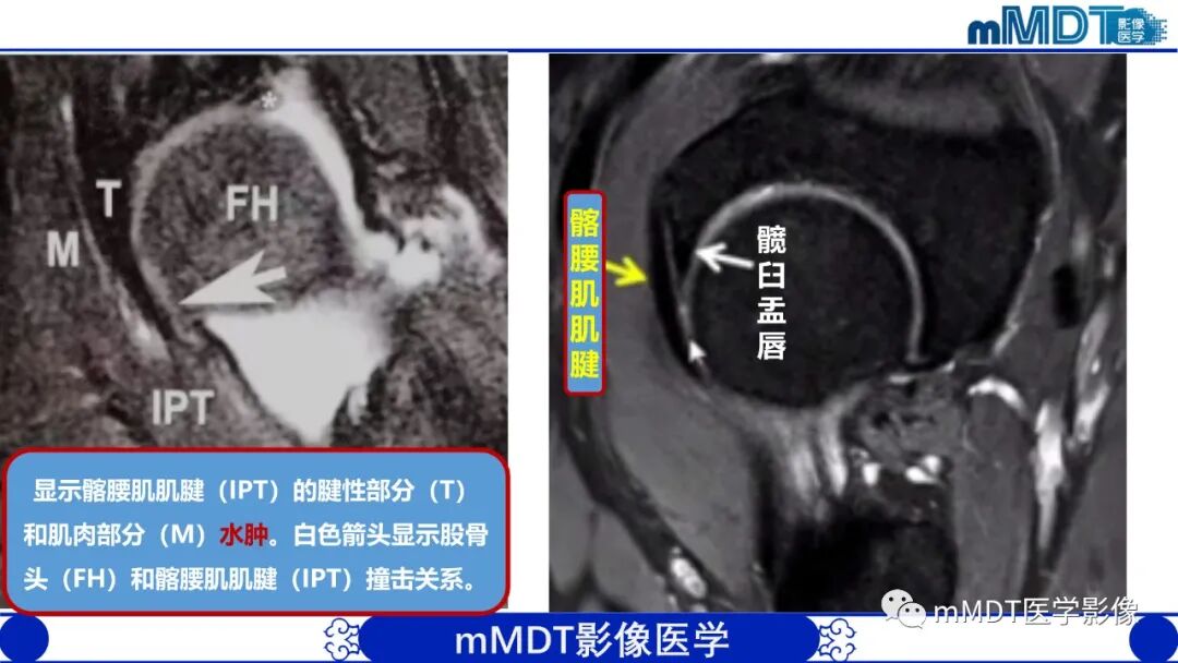 mmd在医学上什么意思髋关节疼痛影像与临床（二）--王勇老师公开课_https://www.jmylbn.com_新闻资讯_第13张