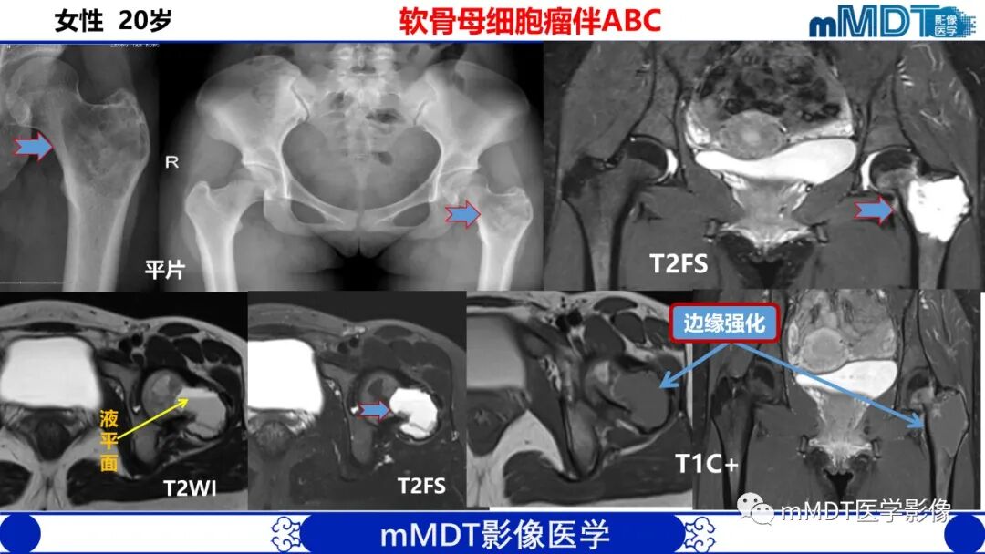 mmd在医学上什么意思髋关节疼痛影像与临床（二）--王勇老师公开课_https://www.jmylbn.com_新闻资讯_第36张