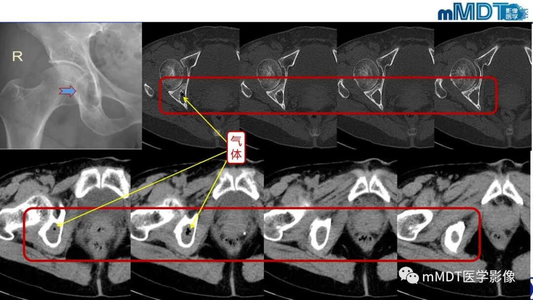 mmd在医学上什么意思髋关节疼痛影像与临床（二）--王勇老师公开课_https://www.jmylbn.com_新闻资讯_第42张