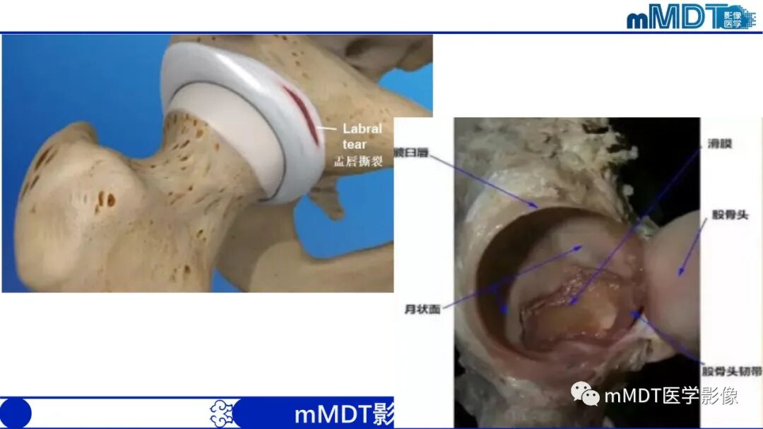 mmd在医学上什么意思髋关节疼痛影像与临床（二）--王勇老师公开课_https://www.jmylbn.com_新闻资讯_第23张