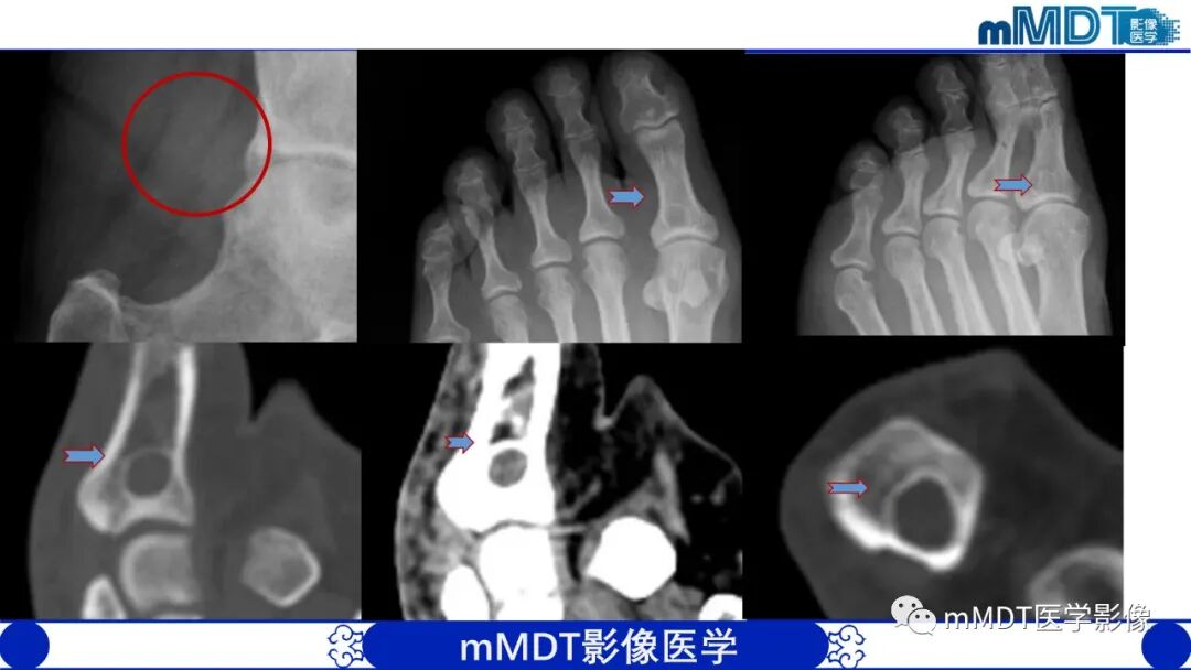 mmd在医学上什么意思髋关节疼痛影像与临床（二）--王勇老师公开课_https://www.jmylbn.com_新闻资讯_第41张