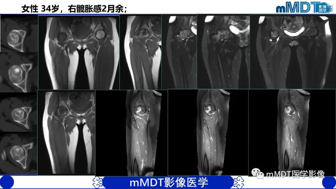 mmd在医学上什么意思髋关节疼痛影像与临床（二）--王勇老师公开课_https://www.jmylbn.com_新闻资讯_第39张