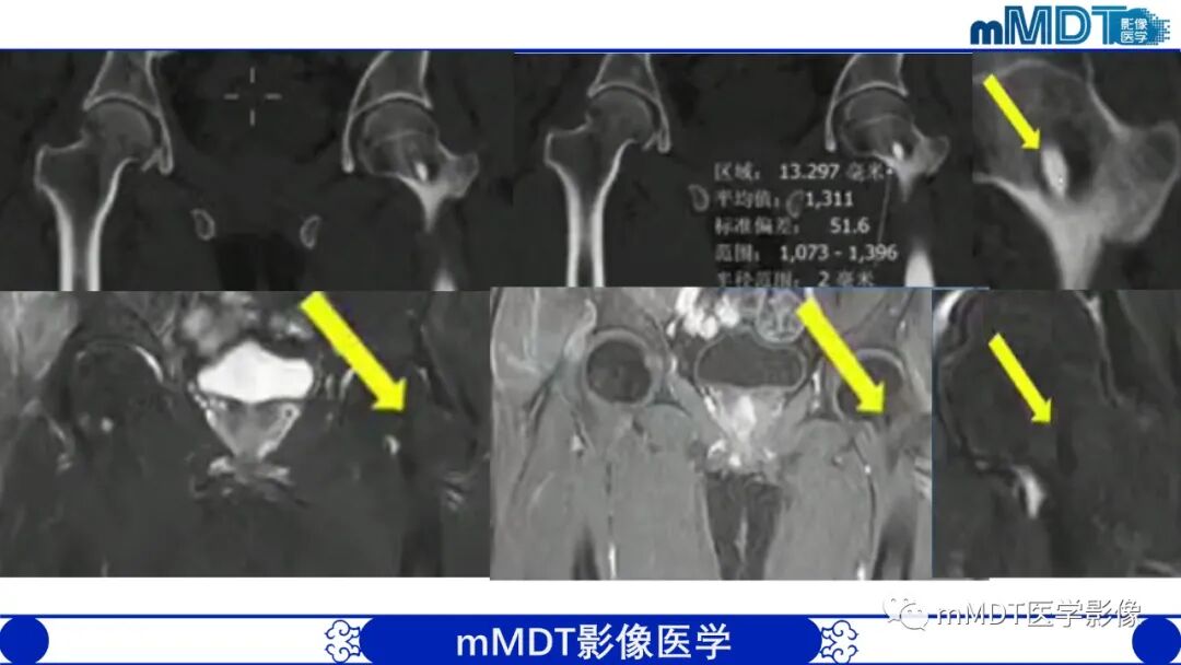 mmd在医学上什么意思髋关节疼痛影像与临床（二）--王勇老师公开课_https://www.jmylbn.com_新闻资讯_第29张